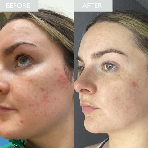 পরিষ্কার ও ব্রণমুক্ত ত্বকের জন্য সেরা সমাধান